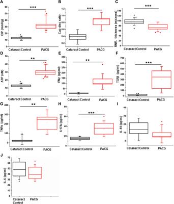 Integrated clinical and metabolomic analysis identifies molecular signatures, biomarkers, and therapeutic targets in primary angle closure glaucoma